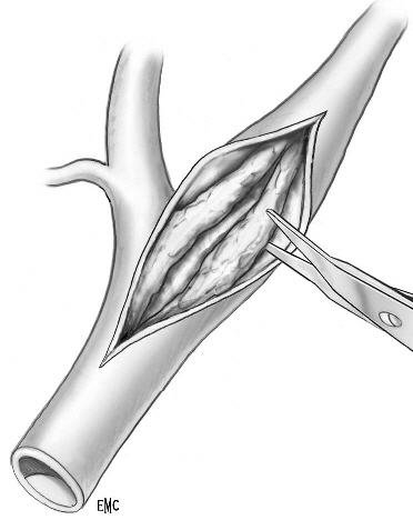 endarérectomie_ciel_ouvert_01.jpg