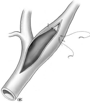 endarérectomie_ciel_ouvert_02.jpg