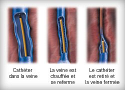 VNUS image 1