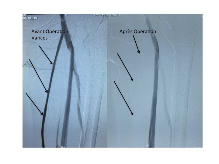 Traitement de varices après RF